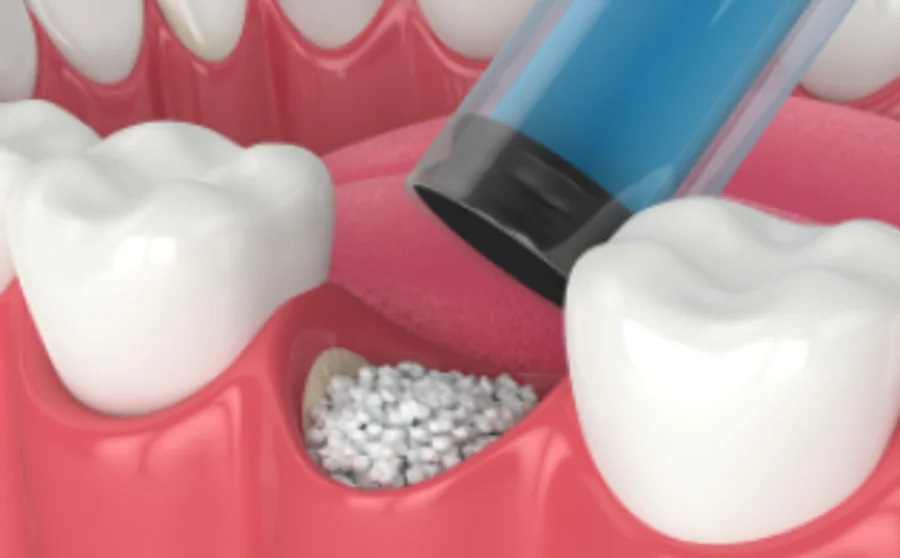 Illustration of bone graft granules being placed into a tooth socket to rebuild the ridge
