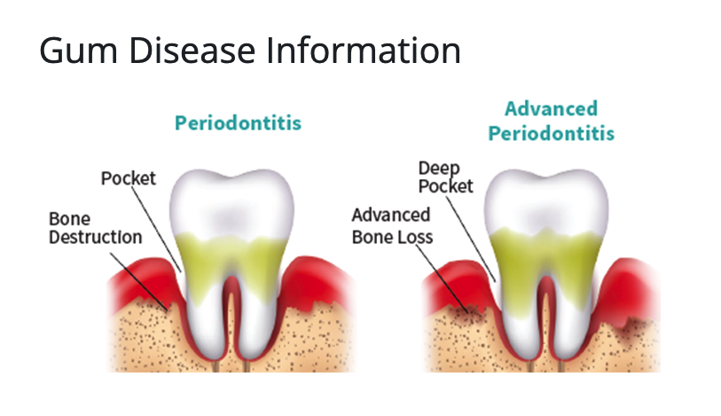 Diagram comparing periodontitis with deepening pockets and bone destruction to advanced periodontitis with deep pockets and advanced bone loss