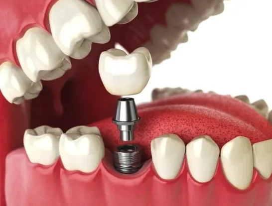 Implant, abutment, and crown shown in a model of the lower jaw