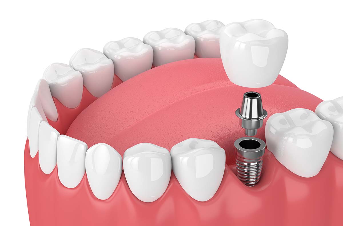 Dental Implants
