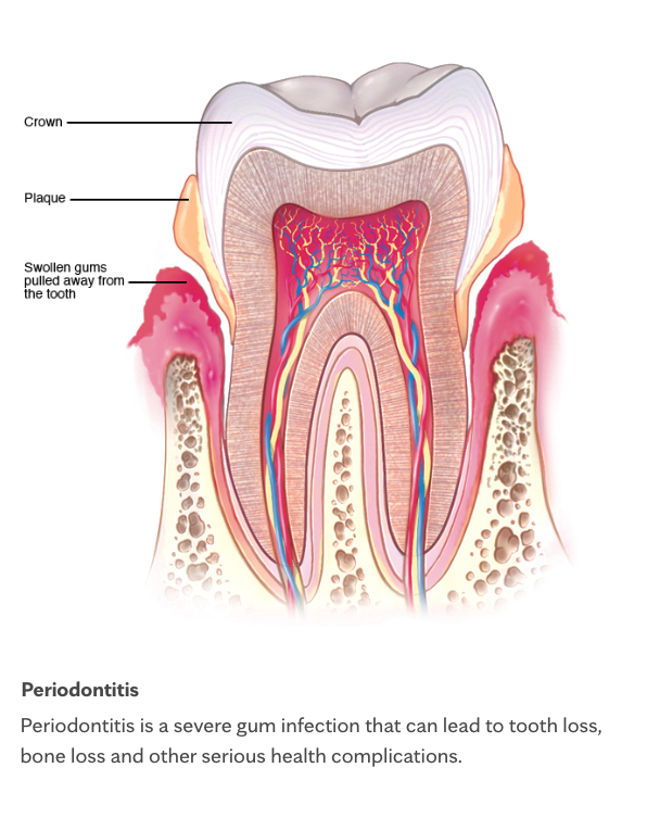 Cross-section of a tooth showing plaque and swollen gums pulling away from the tooth in periodontitis